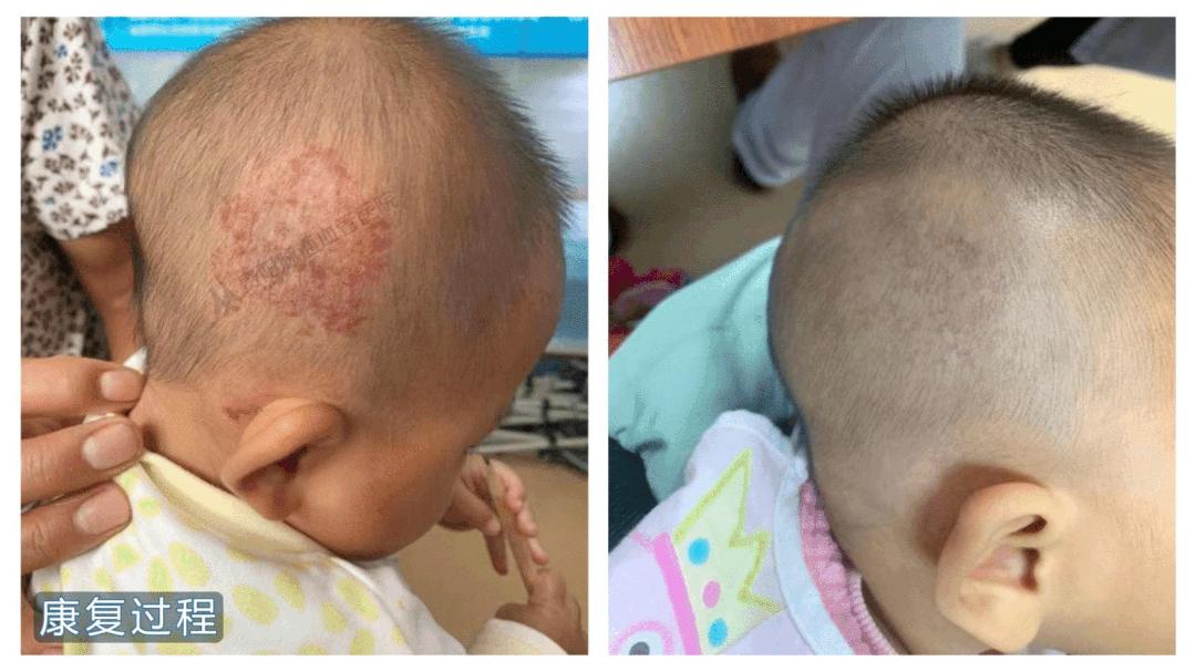 家长注意！2020年贵州血管瘤胎记健康筛查福利已发放仅限45名！速领