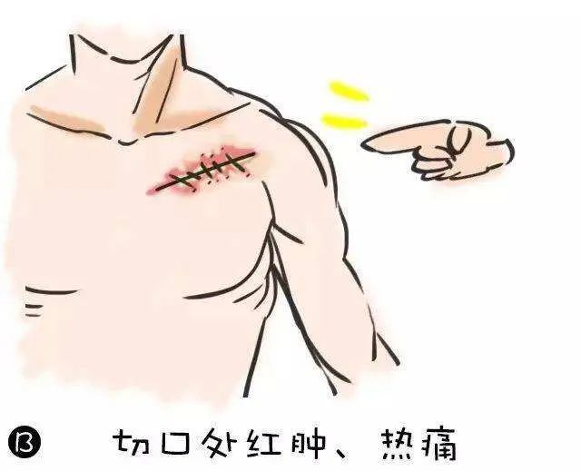 炎症的自述：发生、机理和结局