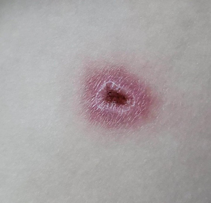 孩子被热水袋低温烫伤怎么办,小朋友晚上睡觉热水袋烫伤