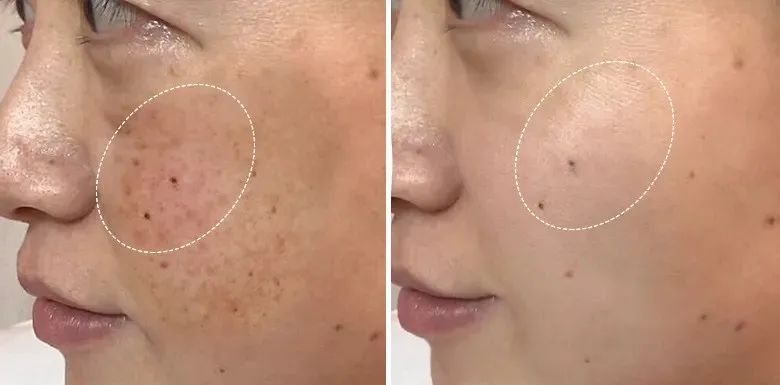 花了3万做激光，才彻底懂了：医生为什么劝你别去斑