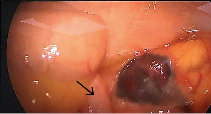 小儿急性腹痛常见原因,急性腹痛伴休克最常见的原因