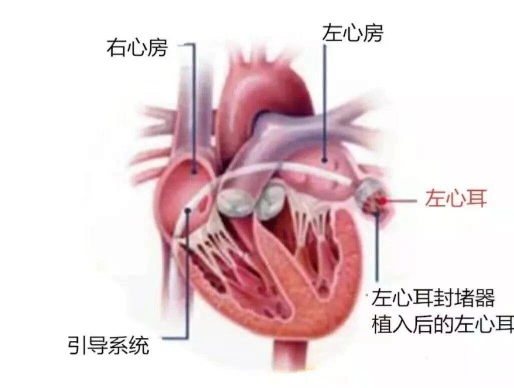 抗凝药为什么会致胃溃疡出血,抗凝药吃多了怎么止血