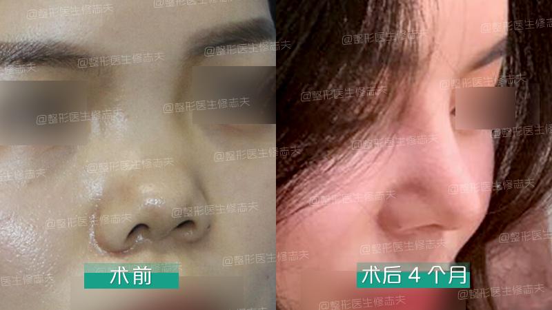 鼻综合整形切口,鼻综合切口处愈合几率