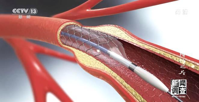 专家说大多数支架没必要做,为何专家说没必要做支架