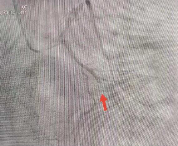 男子突发心梗万幸民警医护在场,男子突发心梗救护士