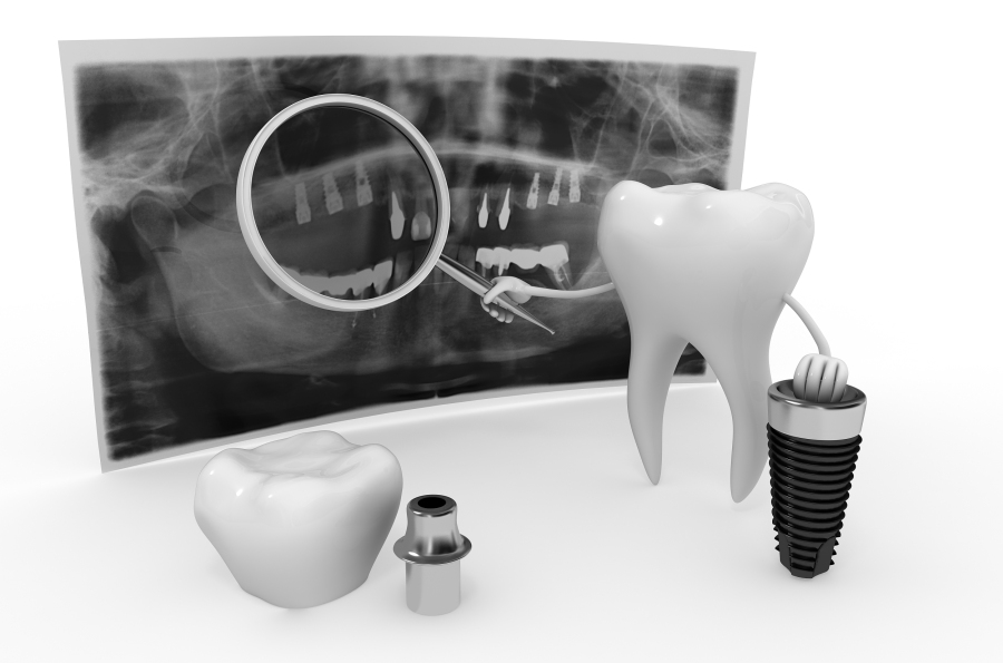 为什么种植一颗牙比一口假牙还贵,假牙成本这么低种牙为啥这么贵