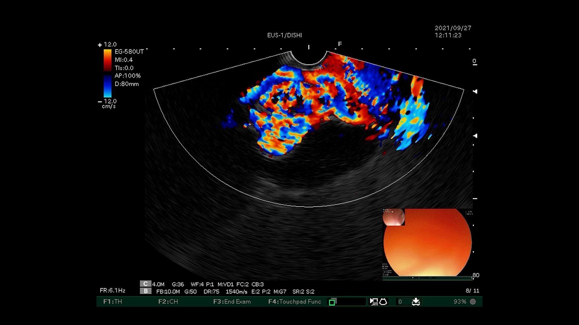 毓璜顶医院国内领先开展超声内镜引导下弹簧圈置入联合组织胶栓塞术治疗伴自发分流的巨大胃底静脉曲张