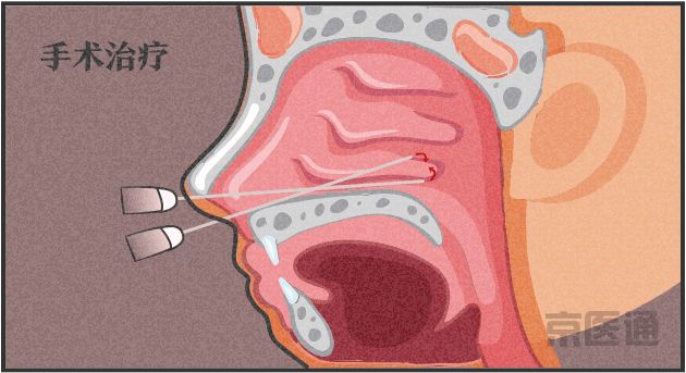 过敏性鼻炎做微创手术可以根治吗,过敏性螨虫鼻炎的根治方法是什么