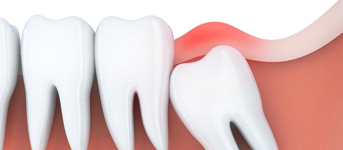 长智齿是不是因为要变聪明,长智齿是不是因为聪明一点