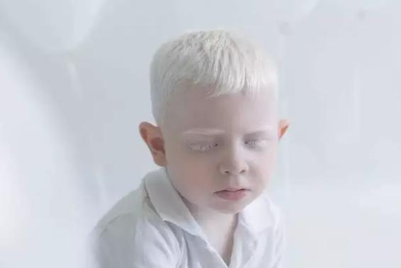 身体上的毛发变白是怎么回事,发现自己皮肤越来越白是病态吗