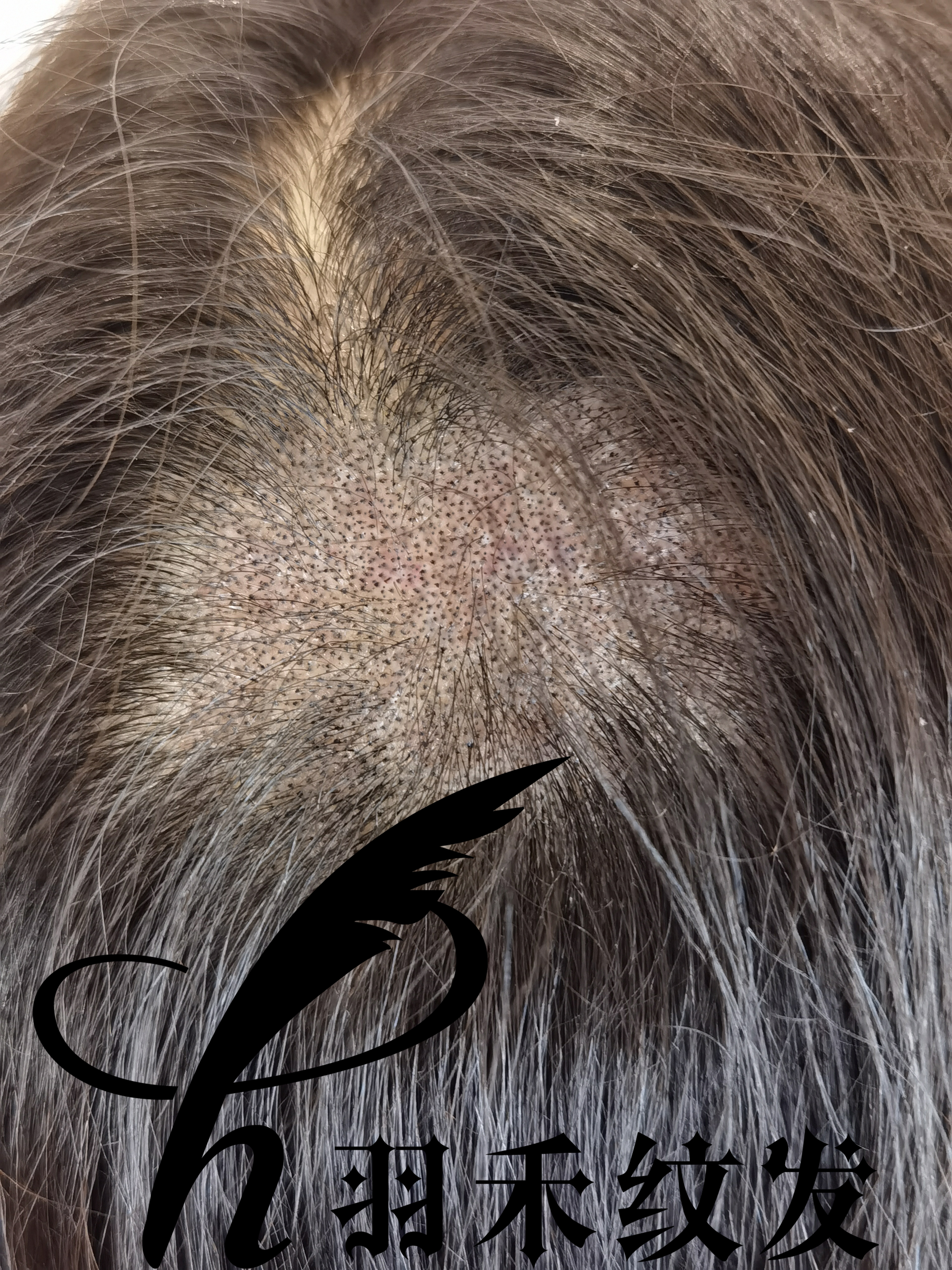 濂冲＋澶撮儴浼ゅ彛濡備綍鍖呮墡,濂冲＋澶撮儴浼ゅ彛缁峰甫鍖呮墡瑙嗛