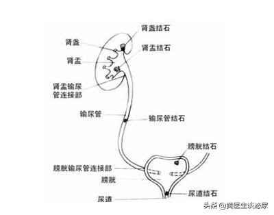 得了输尿管结石怎么办？应该怎么治？