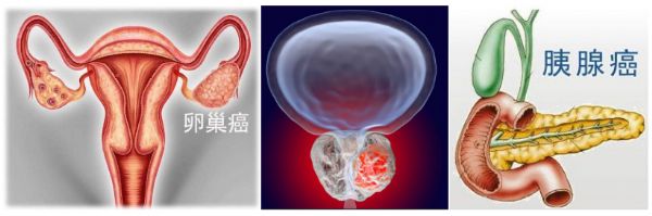 利普卓对胰腺癌有效吗,卵巢癌国内首个新药上市
