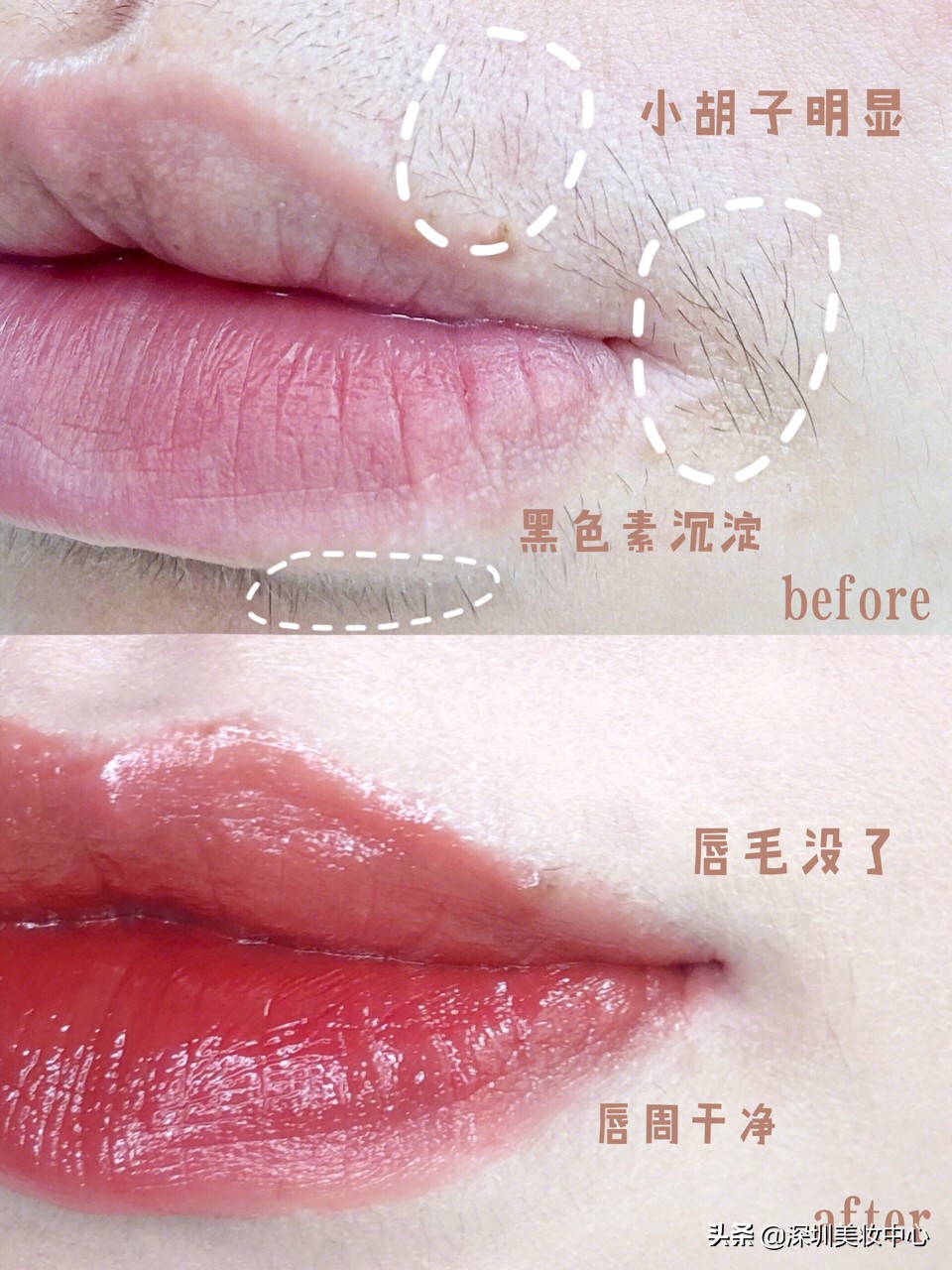 女生有小胡子怎么办小妙招,怎样去除女人嘴唇胡须