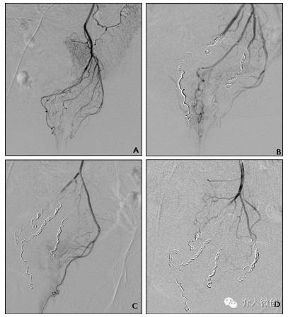 哪种手术治疗痔疮不复发,中医不手术如何治疗痔疮