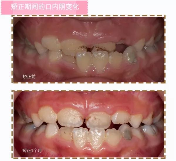 站到台上的“放大镜”女孩，门牙不整齐怎么办？