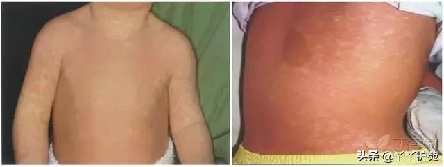 儿科常见出疹性疾病,儿科常见出疹性疾病有哪些