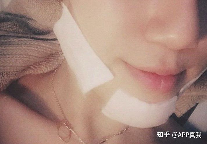 水杨酸棉片可以收缩毛孔吗,水杨酸真的可以收缩毛孔吗