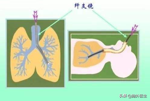 肺结节属于什么肺病,肺结节是什么病需要做化疗吗