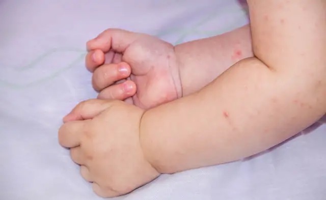 宝宝湿疹哺乳妈妈有必要忌口吗,宝宝湿疹都是妈妈的错