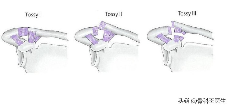 武磊肩锁关节脱位怎么治疗,武磊肩部受伤