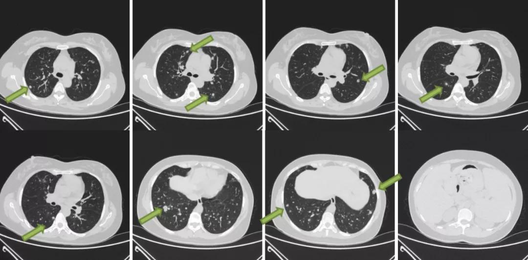 双肺多发结节，反复检查为何诊断重点成「盲区」？