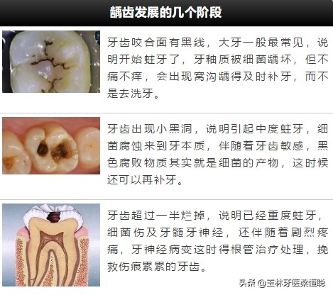 小洞不补大洞吃苦如何理解,小蛀牙洞怎么治疗好得快