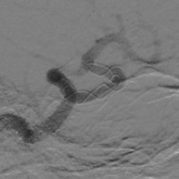 Tubridge®治疗多发性动脉瘤