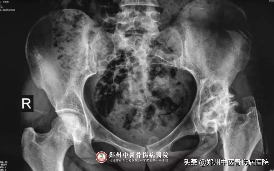 骨坏死并发抑郁症，无路可走时，她在这里看见曙光