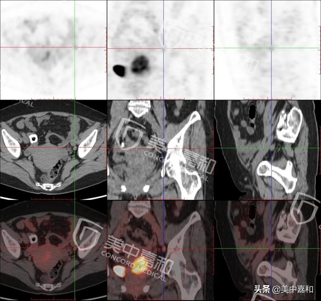 大姨妈突然提前是更年期吗,大姨妈一直来是不是宫颈癌