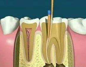 牙齿根管治疗不做牙套是什么样子,牙齿治疗中需要避开的误区