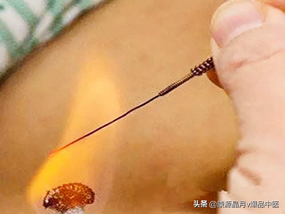 火针治疗额头脂肪瘤视频,火针治疗鸡眼多久才掉痂