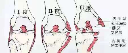 膝关节内侧副韧带损伤症状,膝关节副韧带损伤恢复训练