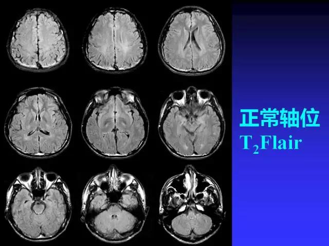 头颅mri读片视频教程,颅脑mri读片入门教程视频讲解全集