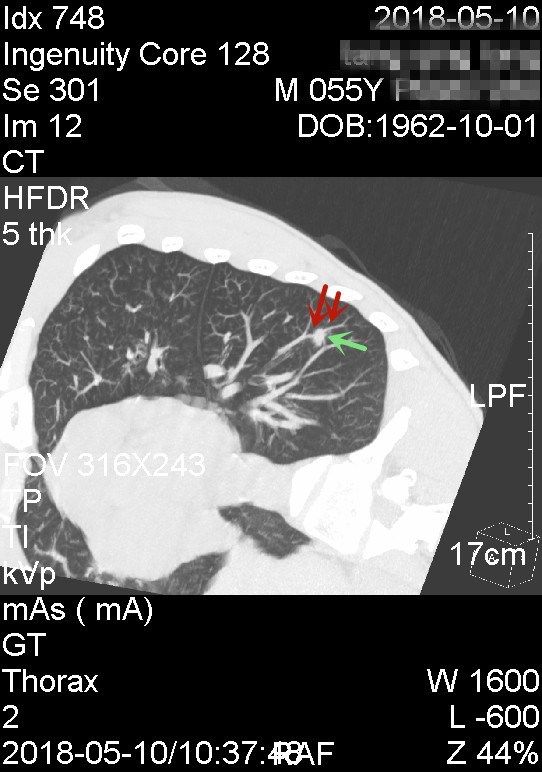结节恶性良性做什么鉴别,恶性肺结节哪些指标偏高