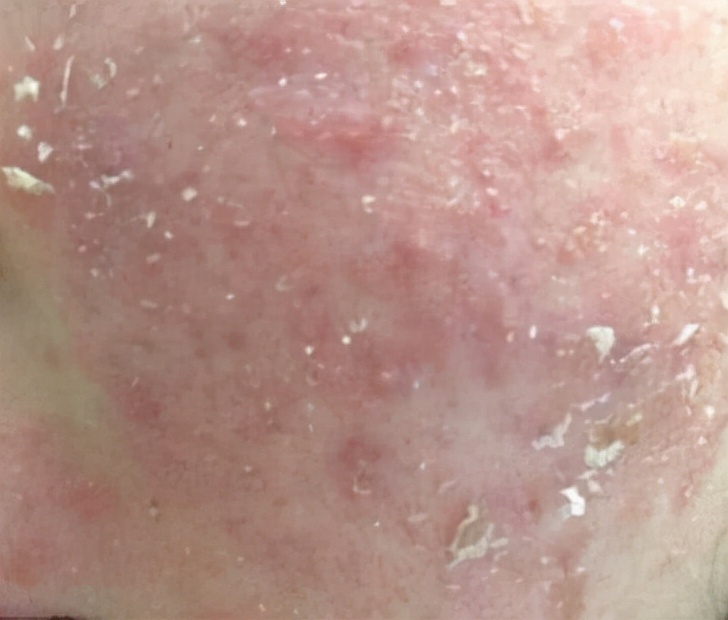 激素依赖性皮炎怎么才能彻底治好,激素可以用于过敏治疗吗