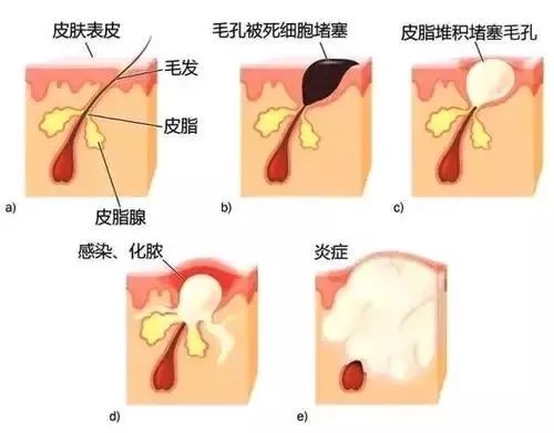 祛痘印小方法和步骤有哪些,痘印肌肤的护肤方法