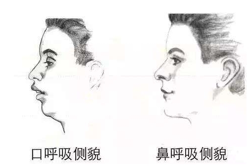 儿童腺样体肥大张口呼吸怎么矫正,小孩腺样体肥大怎么解决张嘴呼吸