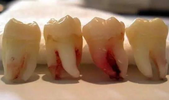 拔完智齿第5天了脸部发肿正常吗,拔完智齿一个月脸部还是有些肿