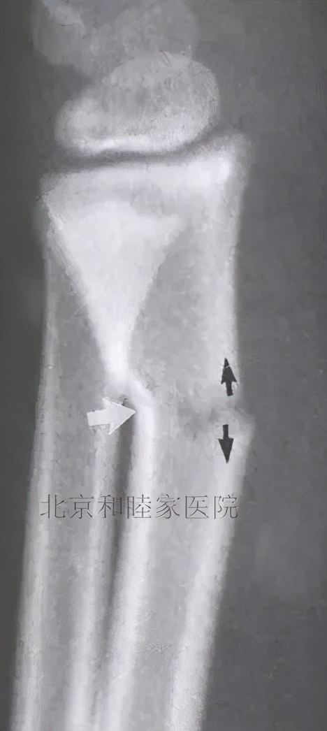 儿童骨折最佳治疗方案,儿童骨折最快恢复方法