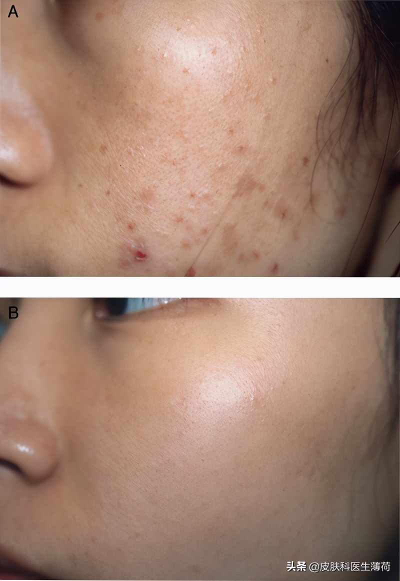 果酸换肤医生讲解,医生不会告诉你的秘密水杨酸