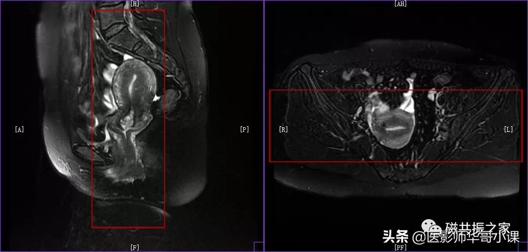 「精品课件」带大家看看,磁共振子宫MRI要如何扫描?