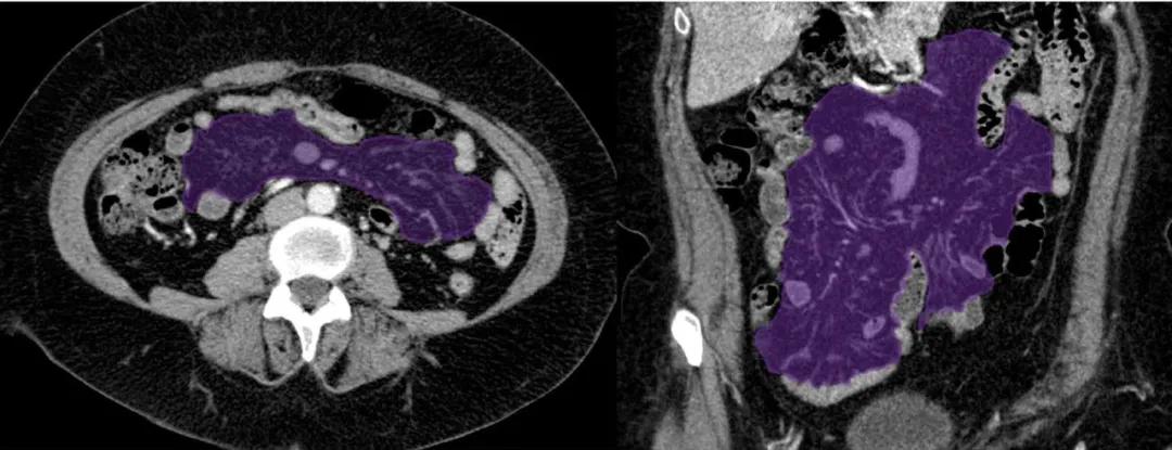 这样的解剖结构容易忘？重新认识肠系膜