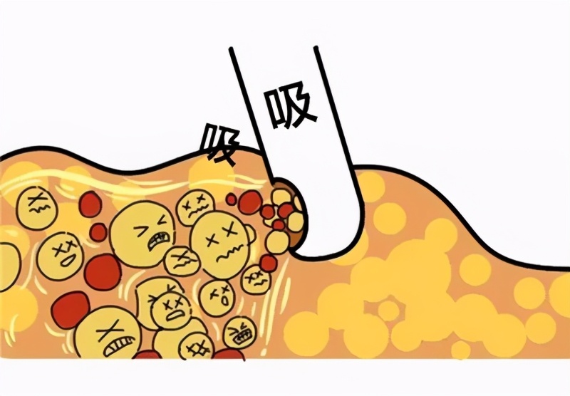 千万不要做减重手术,千万不要做自体脂肪填充