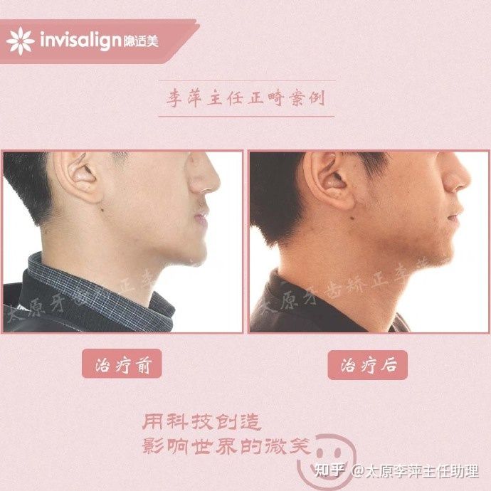 重度拥挤矫正牙齿适合隐形牙套吗,广州成人牙齿矫正推荐隐形牙套