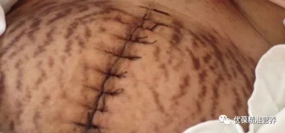 屁股妊娠纹怎么避免,男生妊娠纹如何避免