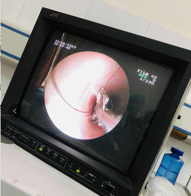 幼儿咳嗽就吐奶是什么原因,3个月大婴儿咳嗽后吐奶怎么回事