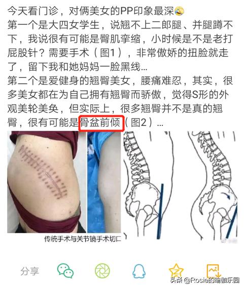 一个动作判断你是不是翘臀,你以为的翘臀很可能是骨盆前倾