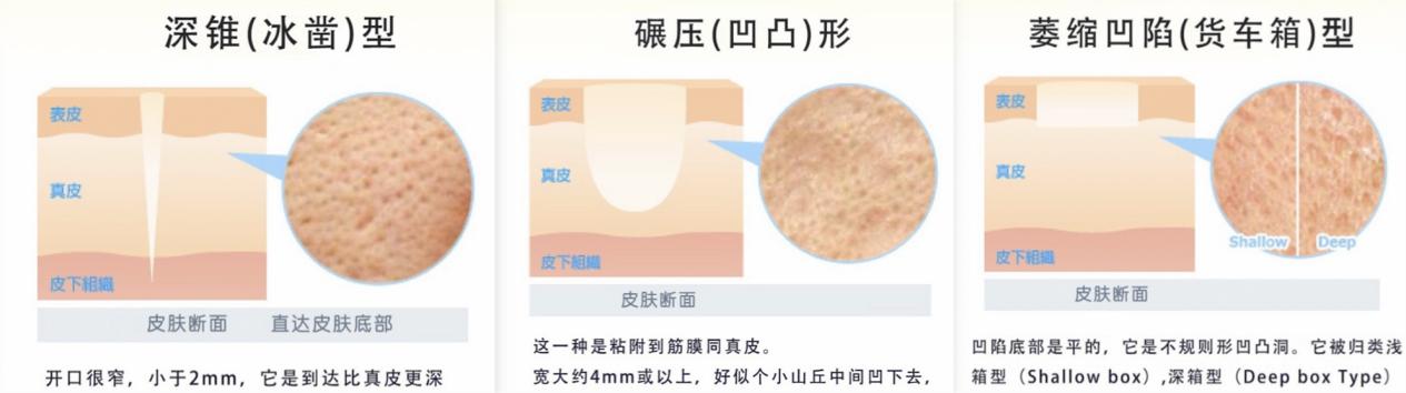 徐州哪家医院修复痘坑效果好,祛痘印修复痘坑排行榜第一名