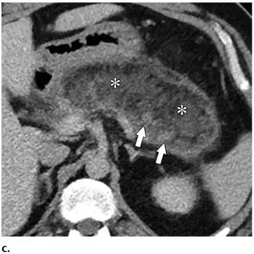 简述急性胰腺炎影像学表现,有关急性胰腺炎疼痛的图片